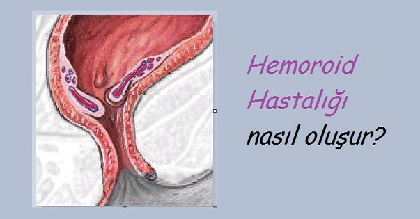 Hemoroid Hastalığı nasıl oluşur?