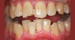 Dişlerin eğri-büğrü çarpık durmasının zararları nelerdir?