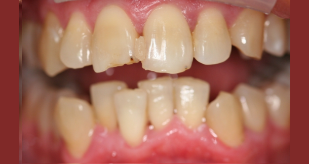 Dişlerin eğri-büğrü çarpık durmasının zararları nelerdir?